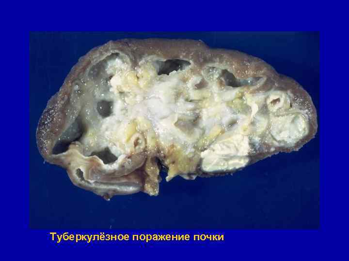 Туберкулёзное поражение почки 