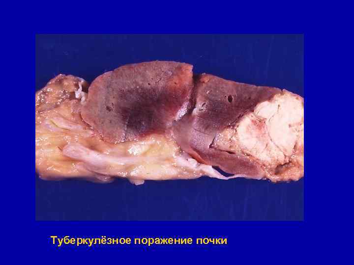 Туберкулёзное поражение почки 
