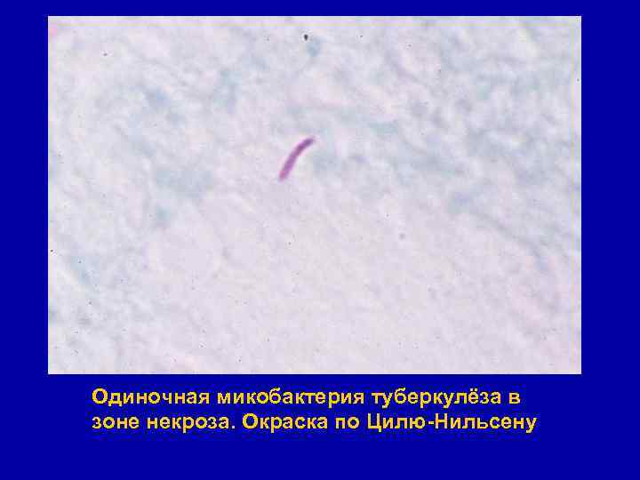 Одиночная микобактерия туберкулёза в зоне некроза. Окраска по Цилю-Нильсену 