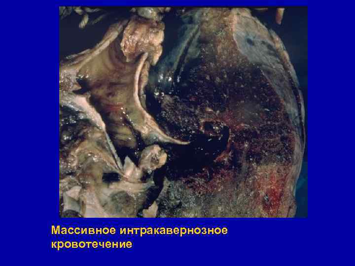 Массивное интракавернозное кровотечение 