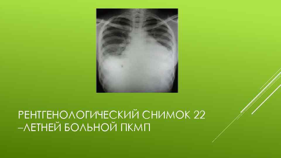 РЕНТГЕНОЛОГИЧЕСКИЙ СНИМОК 22 –ЛЕТНЕЙ БОЛЬНОЙ ПКМП 