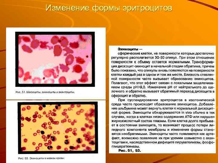 Изменение формы эритроцитов 