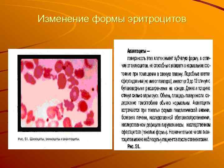 Изменение формы эритроцитов 