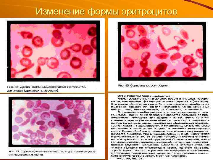 Изменение формы эритроцитов 