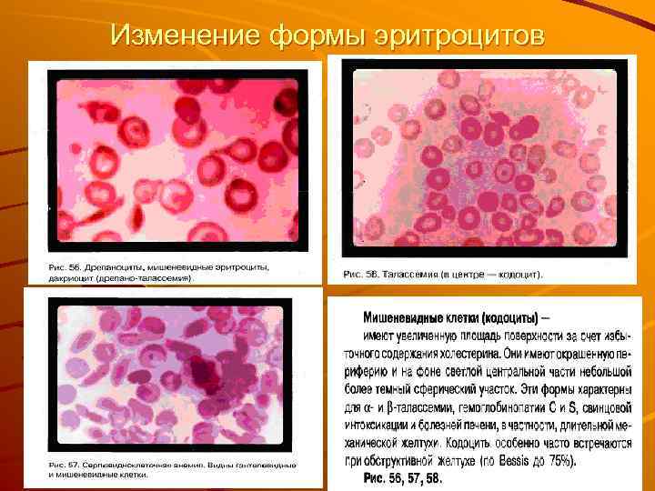 Изменение формы эритроцитов 