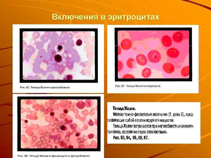 Включения в эритроцитах 