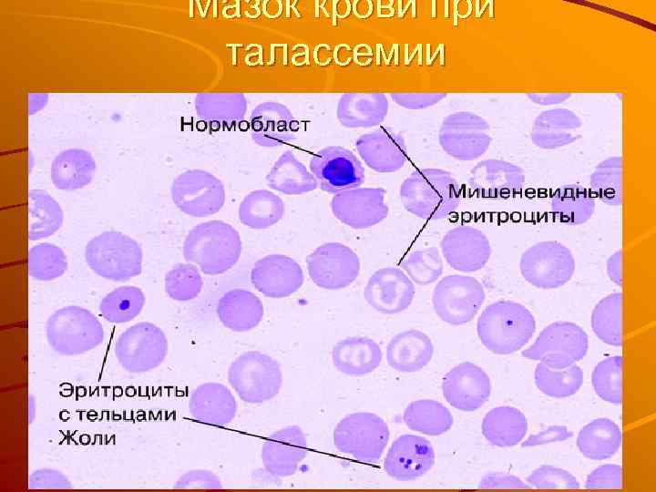 Мазок крови при талассемии 