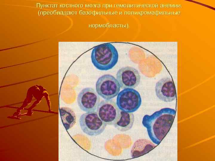 Пунктат костного мозга при гемолитической анемии. (преобладают базофильные и полихромафильные нормобласты). 