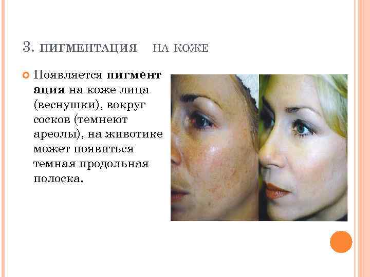 3. ПИГМЕНТАЦИЯ НА КОЖЕ Появляется пигмент ация на коже лица (веснушки), вокруг сосков (темнеют