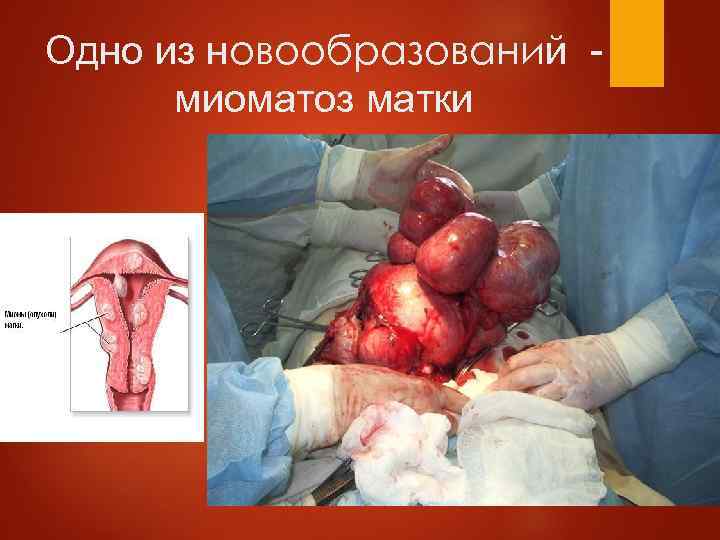 Одно из новообразований миоматоз матки 