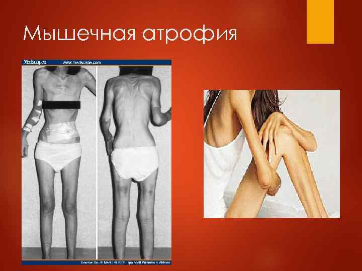 Мышечная атрофия 