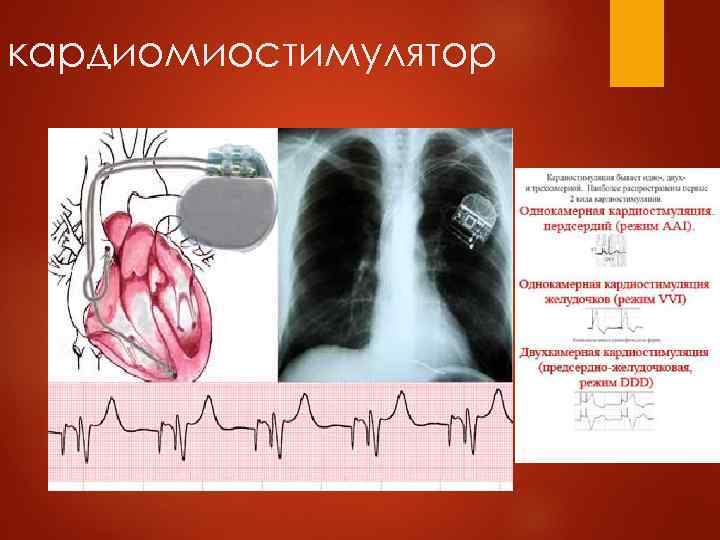 кардиомиостимулятор 