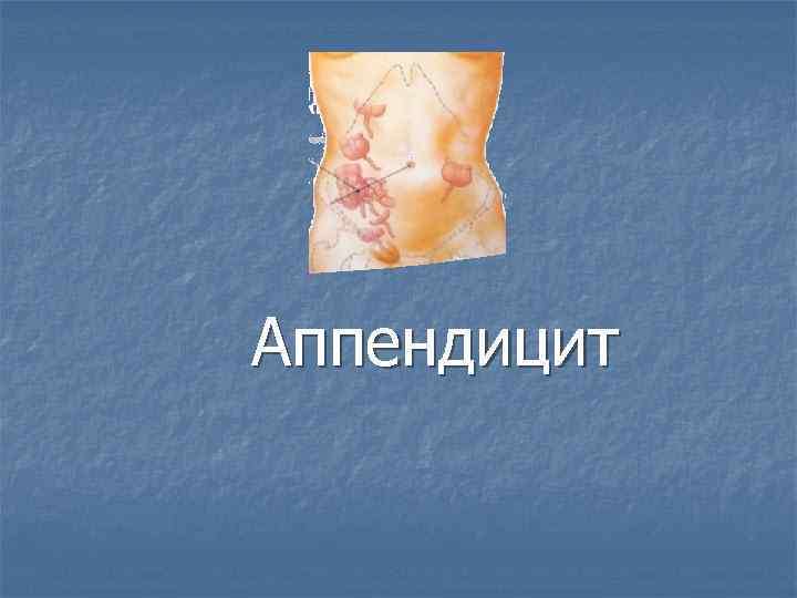 Аппендицит 