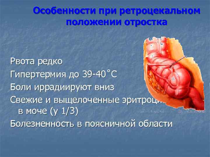 Особенности при ретроцекальном положении отростка Рвота редко Гипертермия до 39 -40˚С Боли иррадиируют вниз
