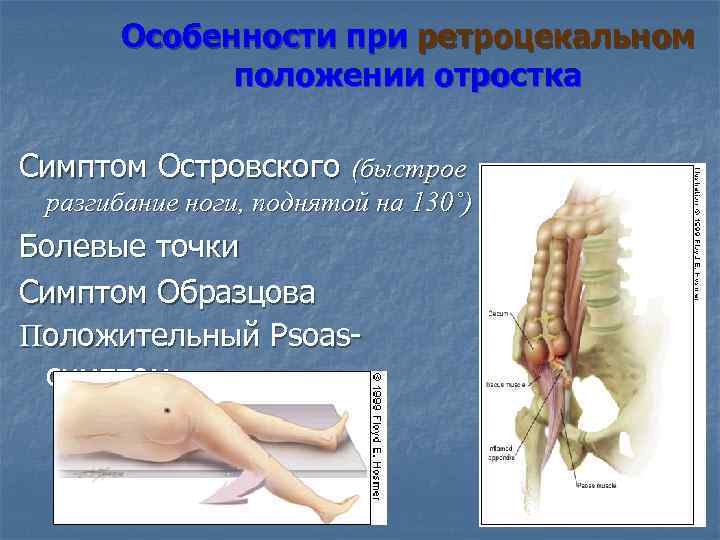 Особенности при ретроцекальном положении отростка Симптом Островского (быстрое разгибание ноги, поднятой на 130˚) Болевые