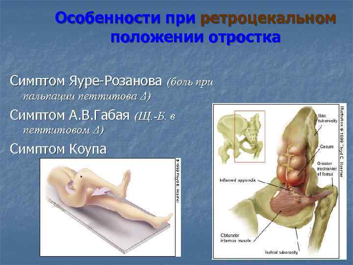 Особенности при ретроцекальном положении отростка Симптом Яуре-Розанова (боль при пальпации петтитова Δ) Симптом А.