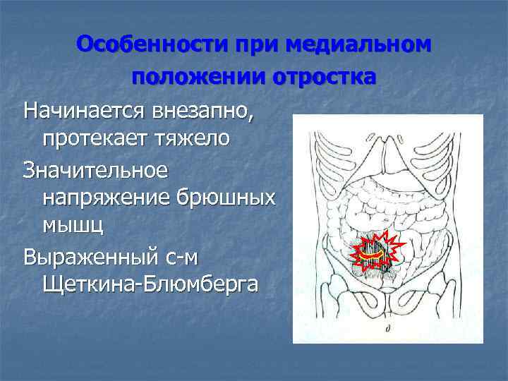 Особенности при медиальном положении отростка Начинается внезапно, протекает тяжело Значительное напряжение брюшных мышц Выраженный