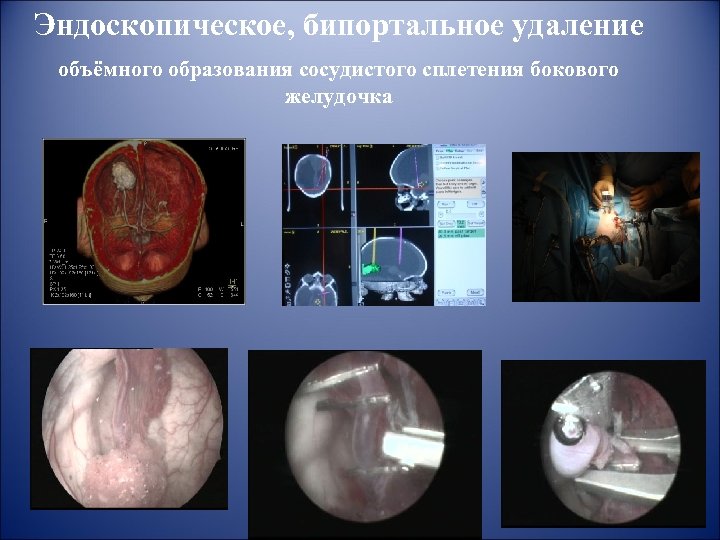 Эндоскопическое, бипортальное удаление объёмного образования сосудистого сплетения бокового желудочка 