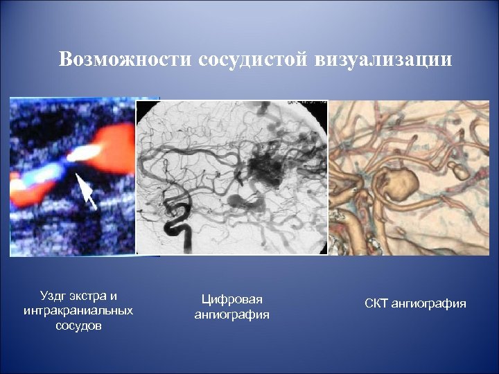 Атеросклероз интракраниального отдела. Ультразвуковая допплерография аорты. Кт ангиография интракраниальных артерий. УЗДГ интракраниальных сосудов. УЗИ интракраниальных артерий.