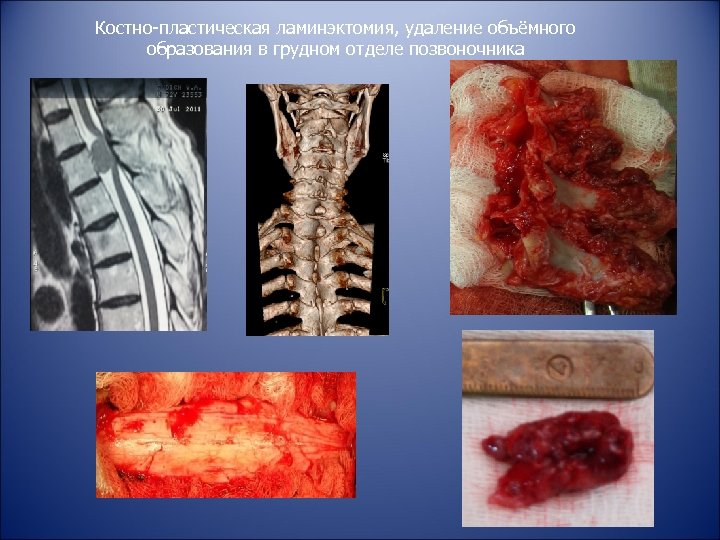 Костно-пластическая ламинэктомия, удаление объёмного образования в грудном отделе позвоночника 