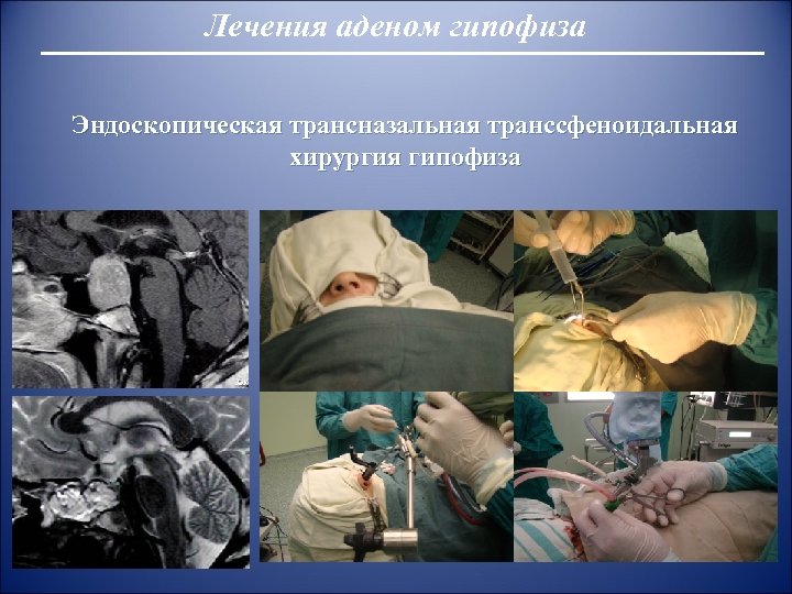 Лечения аденом гипофиза Эндоскопическая трансназальная транссфеноидальная хирургия гипофиза 