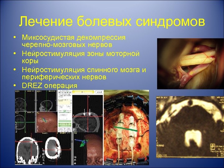 Лечение болевых синдромов • Миксосудистая декомпрессия черепно-мозговых нервов • Нейростимуляция зоны моторной коры •