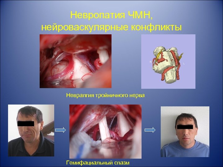 Невропатия ЧМН, нейроваскулярные конфликты Невралгия тройничного нерва Гемифациальный спазм 
