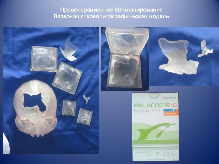 Предоперационное 3 D планирование Лазерная стереолитографическая модель 