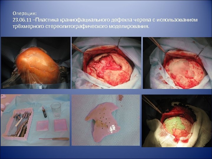 Операция: 23. 06. 11 –Пластика краниофациального дефекта черепа с использованием трёхмерного стереолитографического моделирования. 