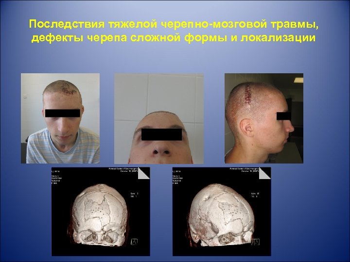 Последствия тяжелой черепно-мозговой травмы, дефекты черепа сложной формы и локализации 