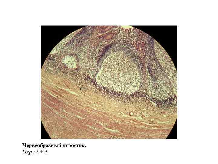 Червеобразный отросток. Окр. : Г+Э. 