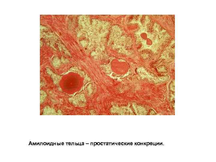 Амилоидные тельца – простатические конкреции. 