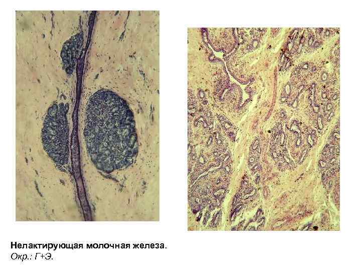 Нелактирующая молочная железа. Окр. : Г+Э. 