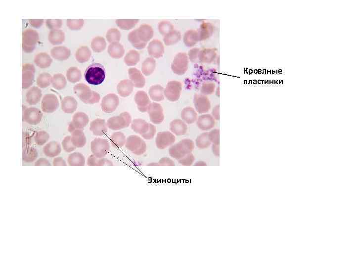 Кровяные пластинки Эхиноциты 