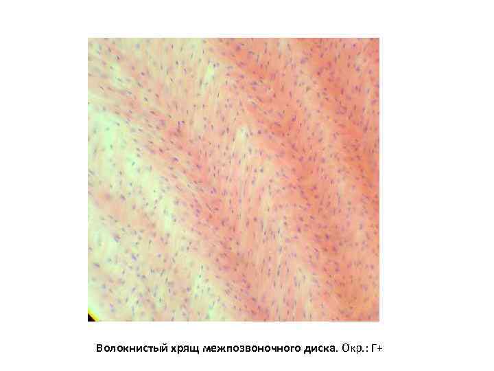 Волокнистый хрящ межпозвоночного диска. Окр. : Г+ 