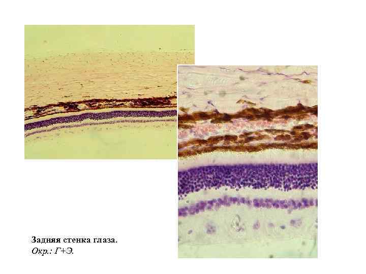 Задняя стенка глаза. Окр. : Г+Э. 