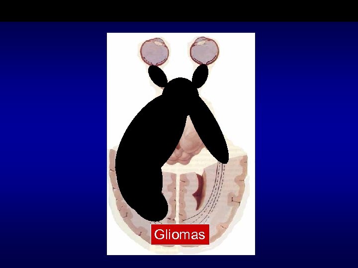 Gliomas 
