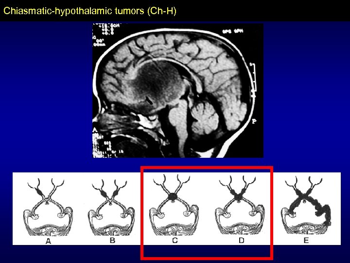 Chiasmatic-hypothalamic tumors (Ch-H) 