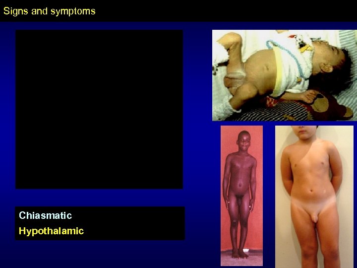 Signs and symptoms Chiasmatic Hypothalamic 