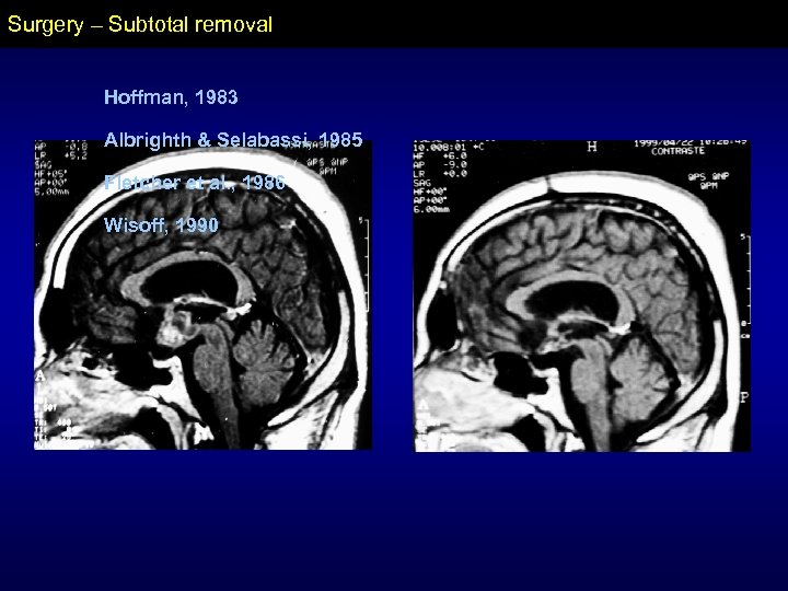 Surgery – Subtotal removal Hoffman, 1983 Albrighth & Selabassi, 1985 Fletcher et al. ,