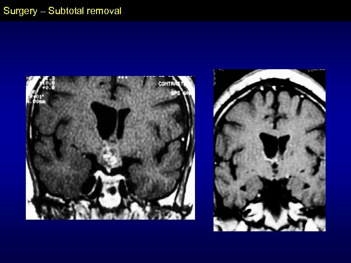 Surgery – Subtotal removal 