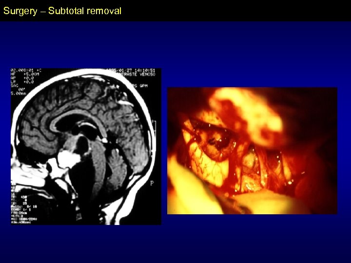 Surgery – Subtotal removal 