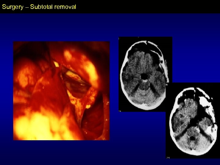 Surgery – Subtotal removal 
