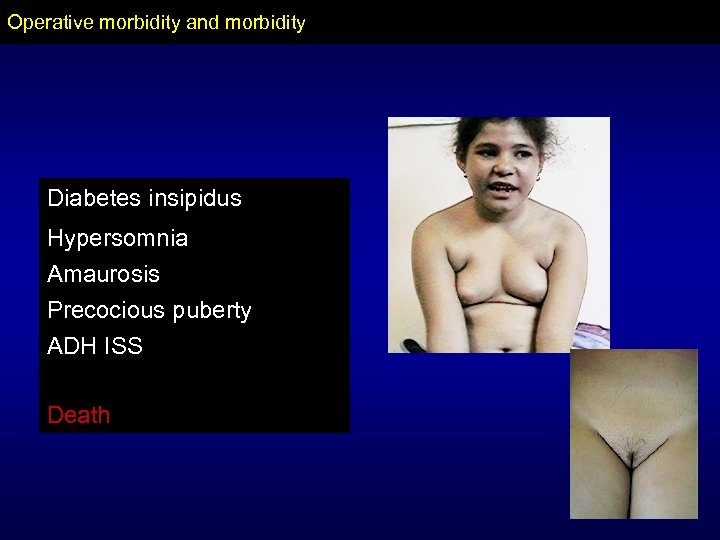 Operative morbidity and morbidity Diabetes insipidus Hypersomnia Amaurosis Precocious puberty ADH ISS Death 