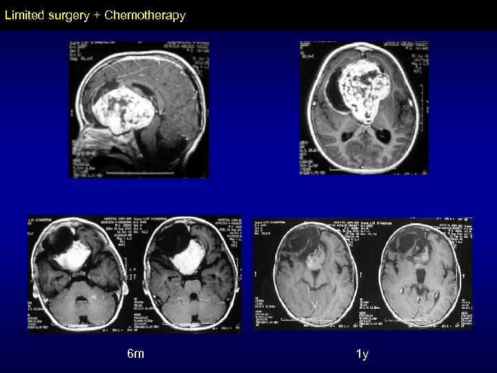 Limited surgery + Chemotherapy 6 m 1 y 