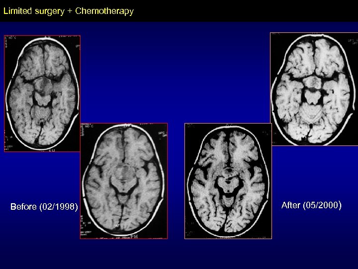 Limited surgery + Chemotherapy Before (02/1998) After (05/2000) 