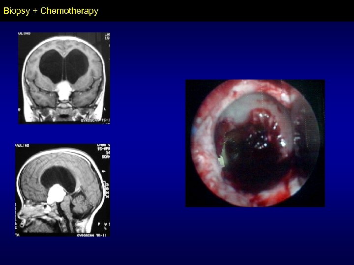 Biopsy + Chemotherapy 