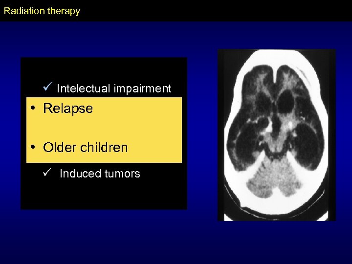Radiation therapy ü Intelectual impairment • ü Visual impairment Relapse • ü Endocrine impairment