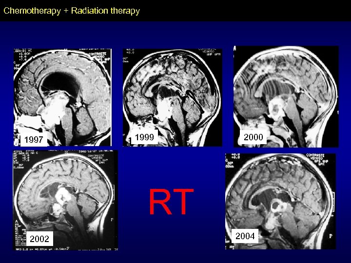Chemotherapy + Radiation therapy 1997 1999 2000 RT 2002 2004 