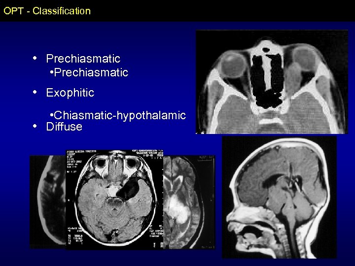 OPT - Classification • Prechiasmatic • Exophitic • Chiasmatic-hypothalamic • Diffuse 
